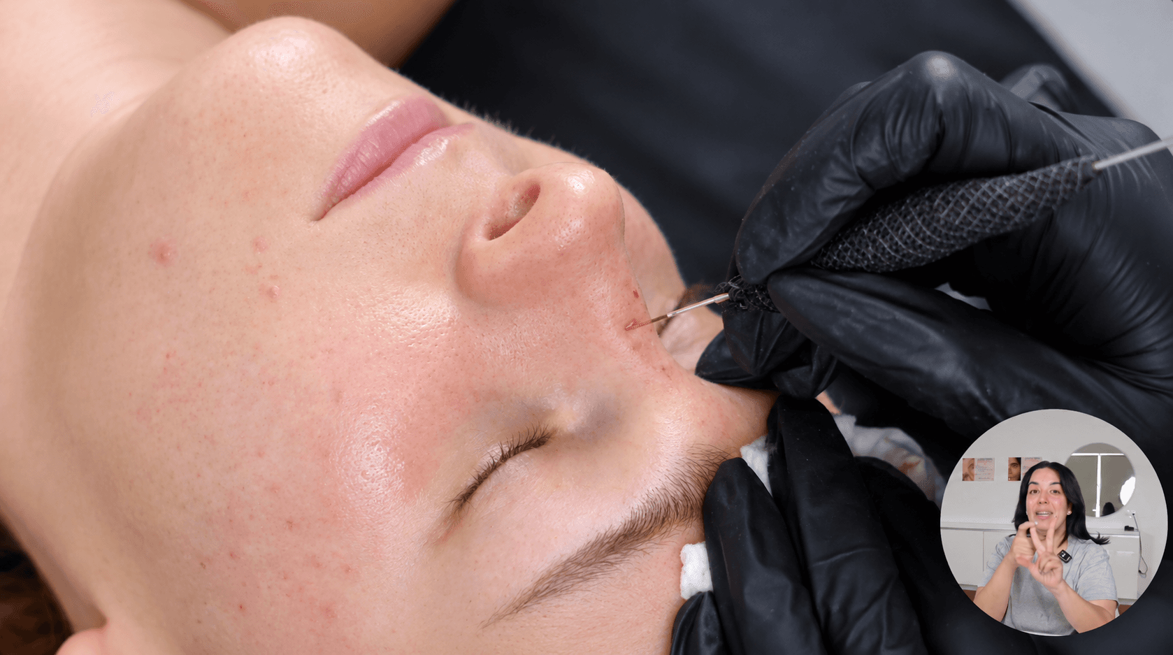 Pigmentation des faux freckles en 4 étapes
