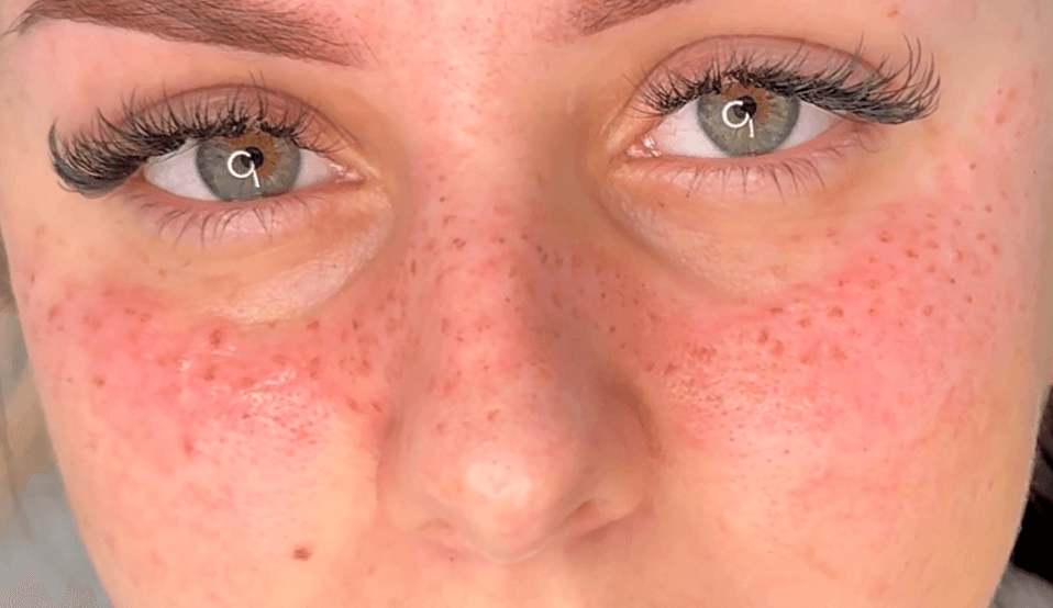 Tatouage semi-permanent de faux freckles très subtils avec pigments clairs (blonds/roux) sur peau très claire, pour un effet "no makeup" ultra naturel par Habiba Med.