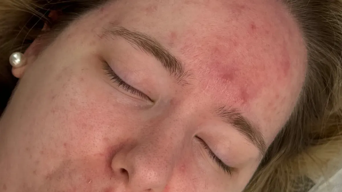 Acne-prone skin with intense redness: the appointment is postponed