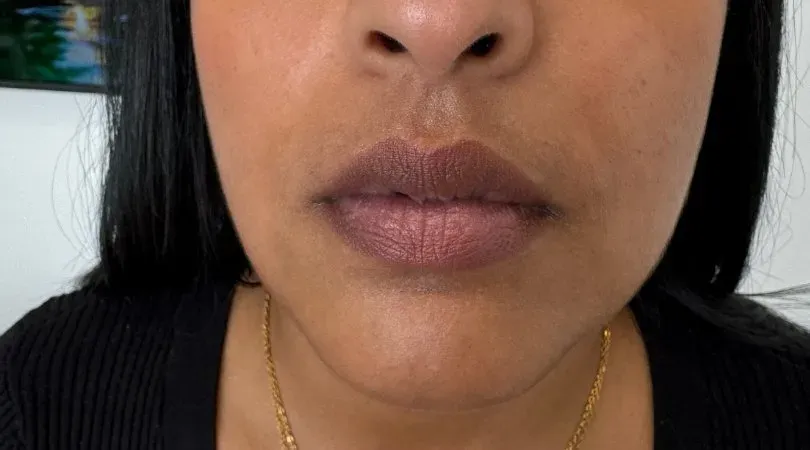 Dark lips that need lip neutralization