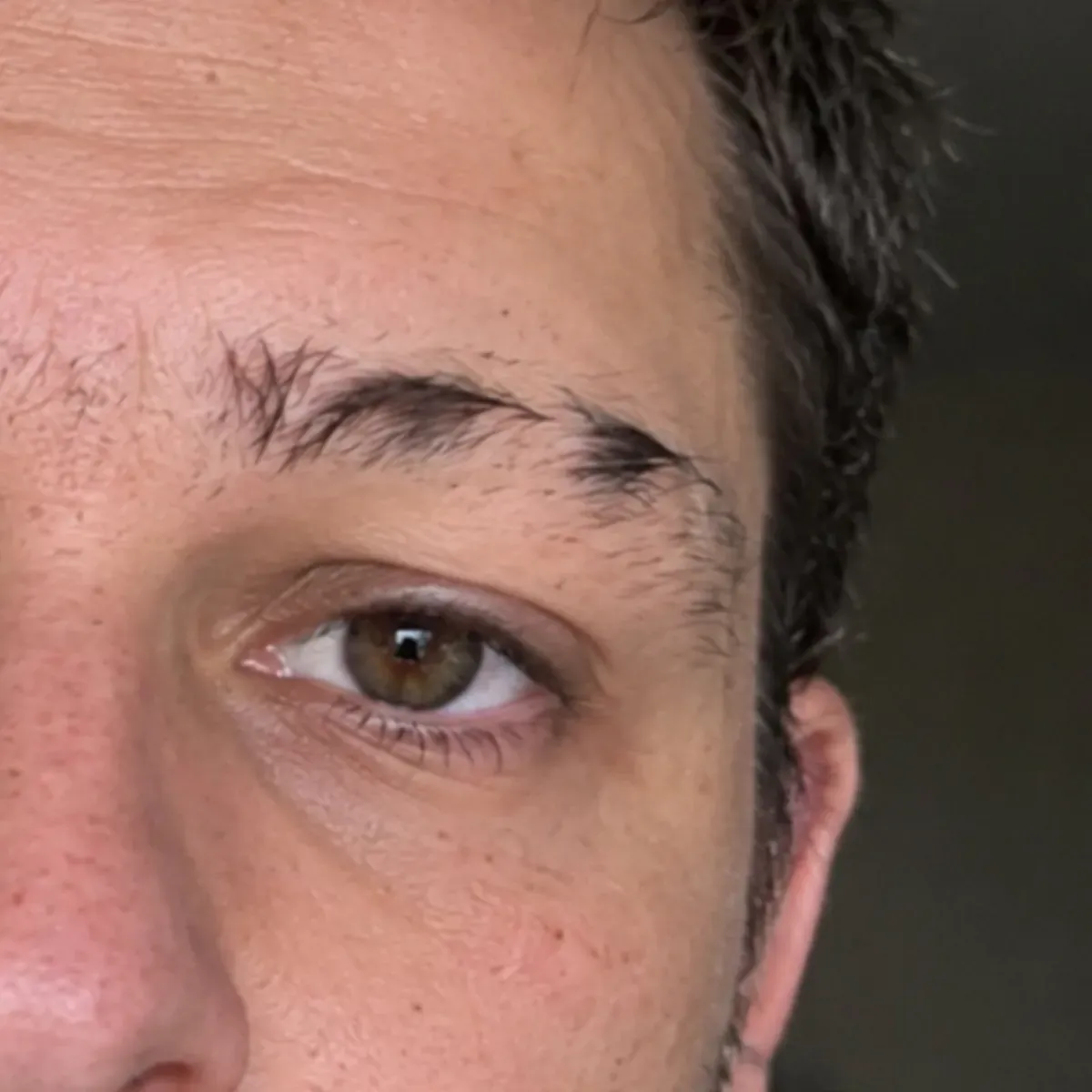 Man with eyebrow alopecia