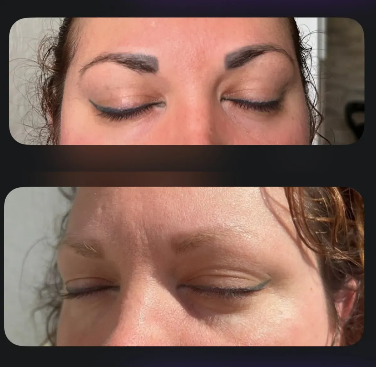 Permanent Make-up an den Augenbrauen mit Laser entfernt: vorher und nach 4 Sitzungen, 90 % des alten Pigments sind weg