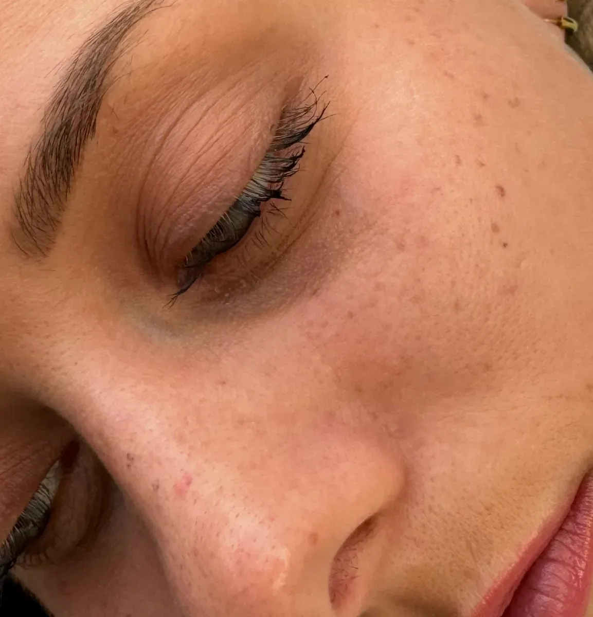 Healed freckles, 1 to 2 years later: almost gone, with no color change