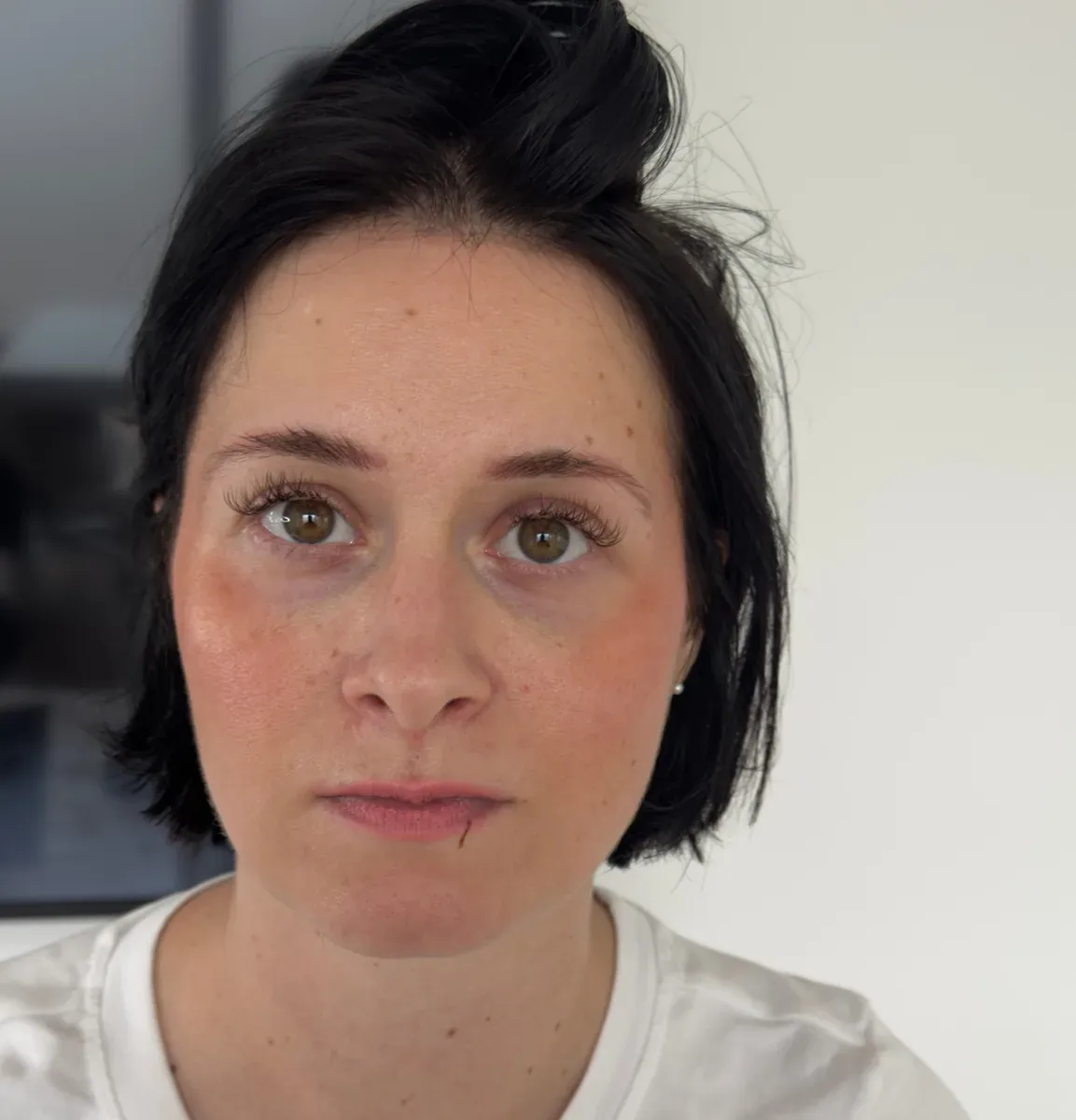 Client 1, before: a face with no freckles