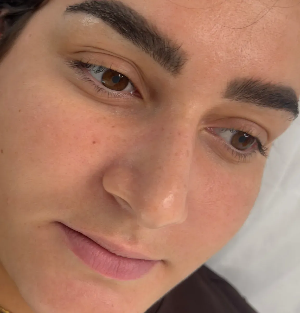 A third client, 1 to 2 years later: the freckles are gone