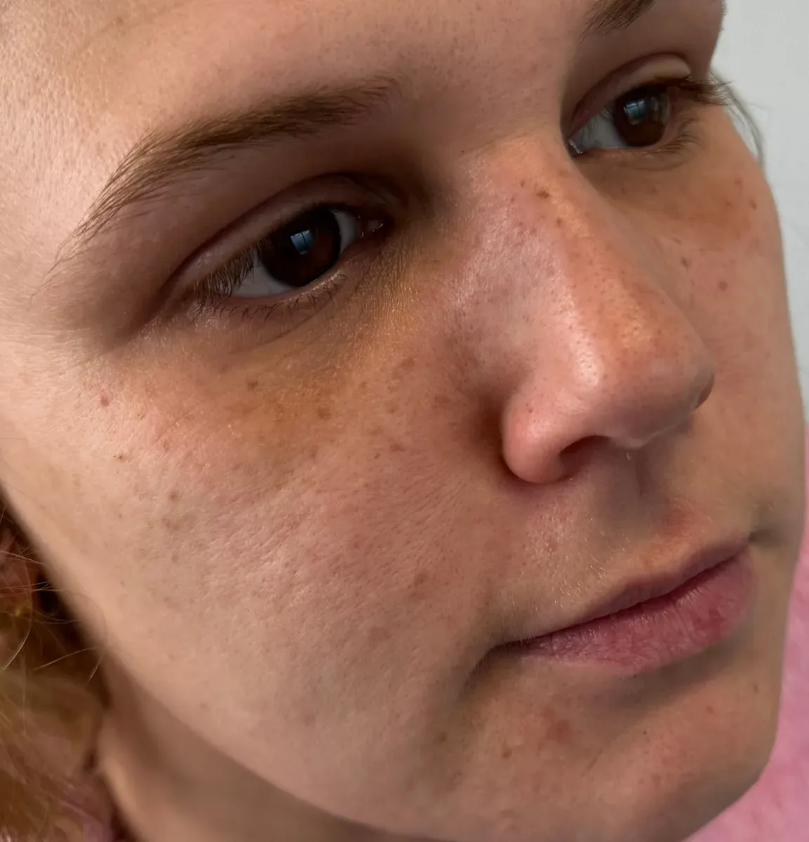 Another client, 1 to 2 years later: the freckles have almost disappeared