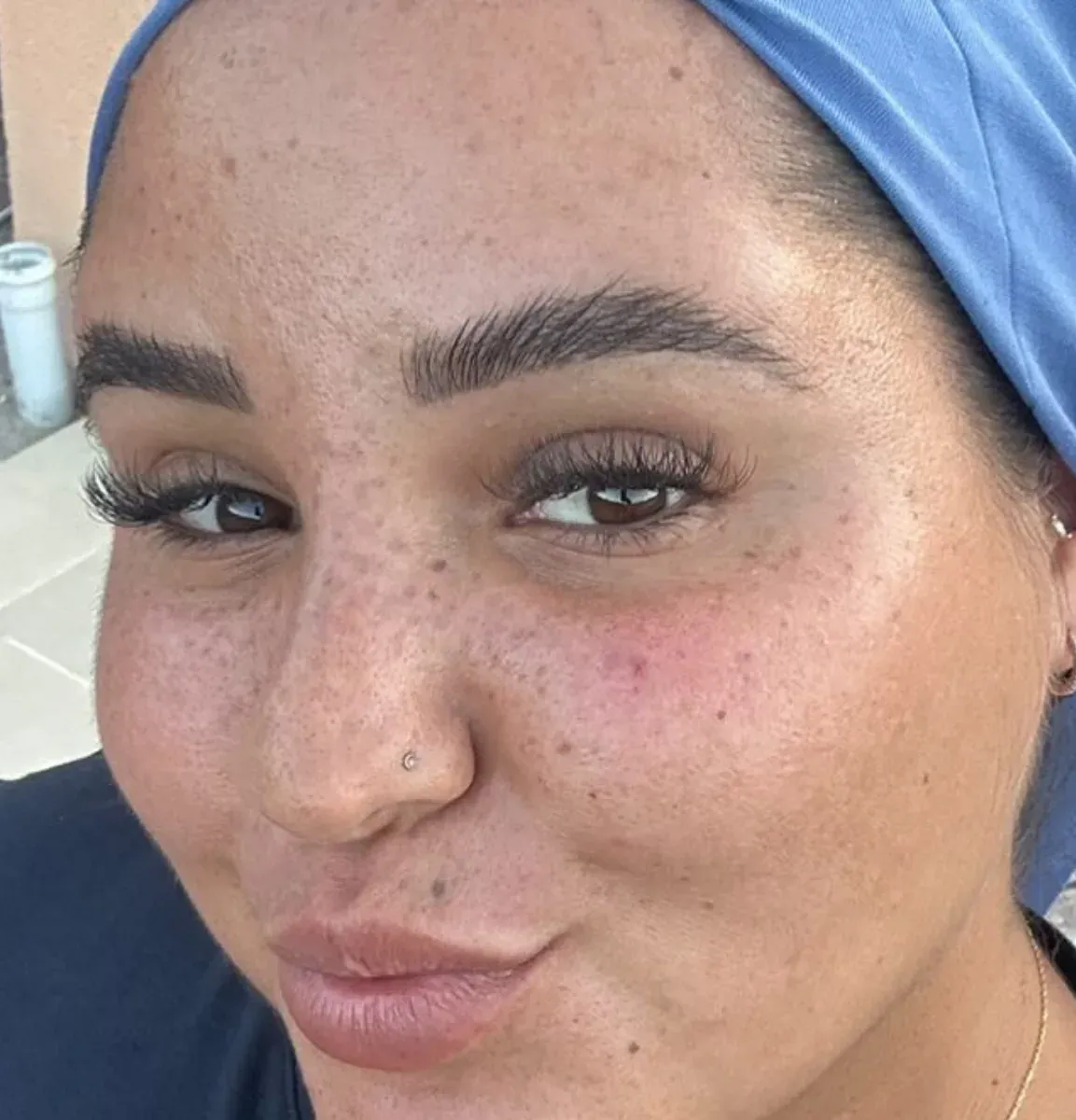 Healed permanent makeup freckles