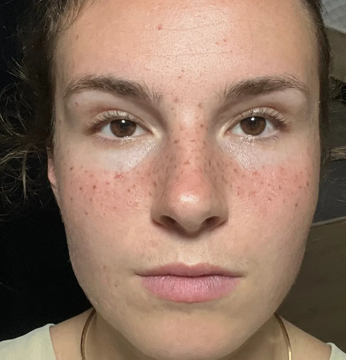 In the first few days, the freckles get even darker