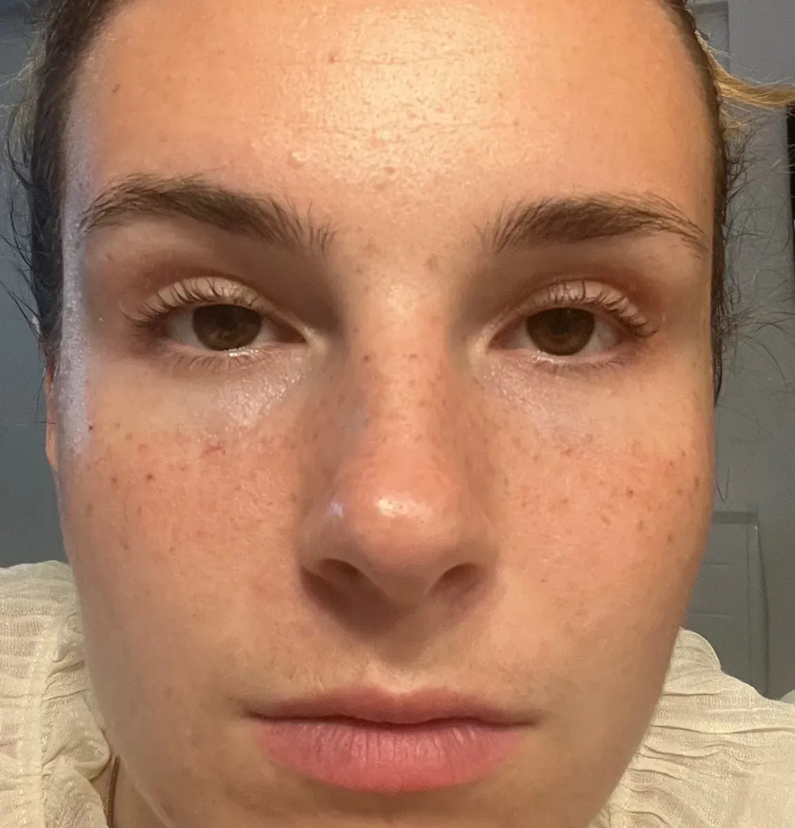 After the scabs, the freckles seem to disappear: the color will come back