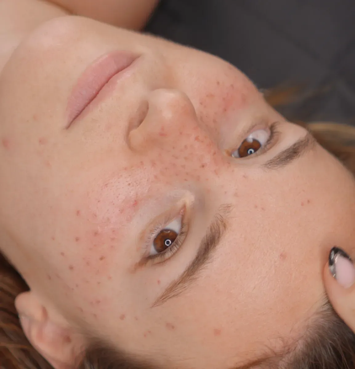 On the day, right after tattooing: the freckles are nice and dark