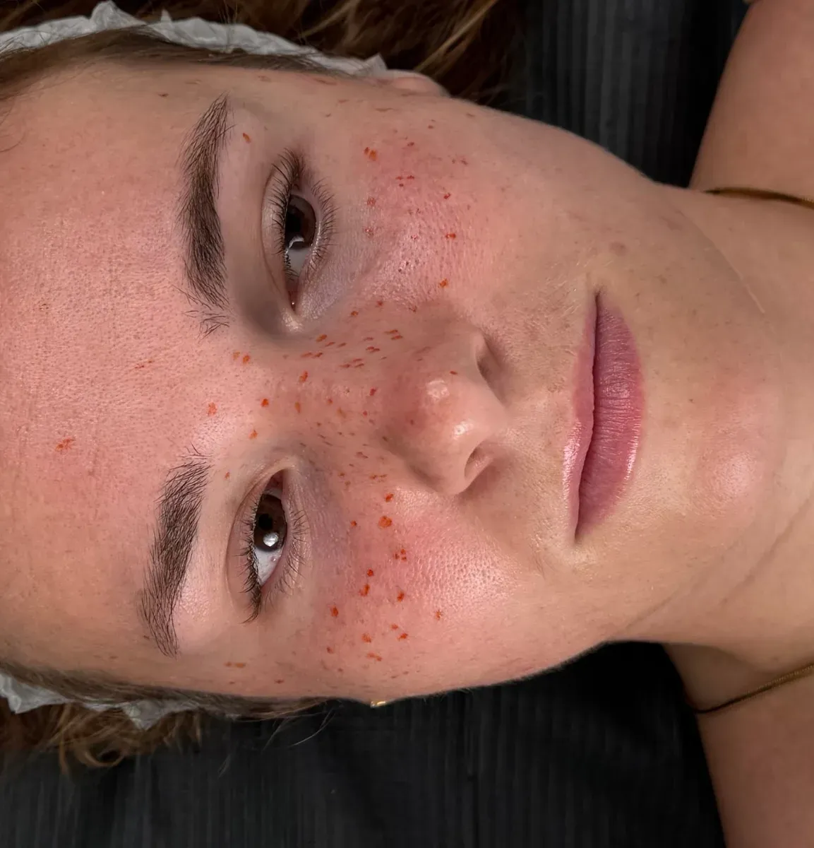 Freckles drawn with a felt-tip pen (mapping) before pigmentation