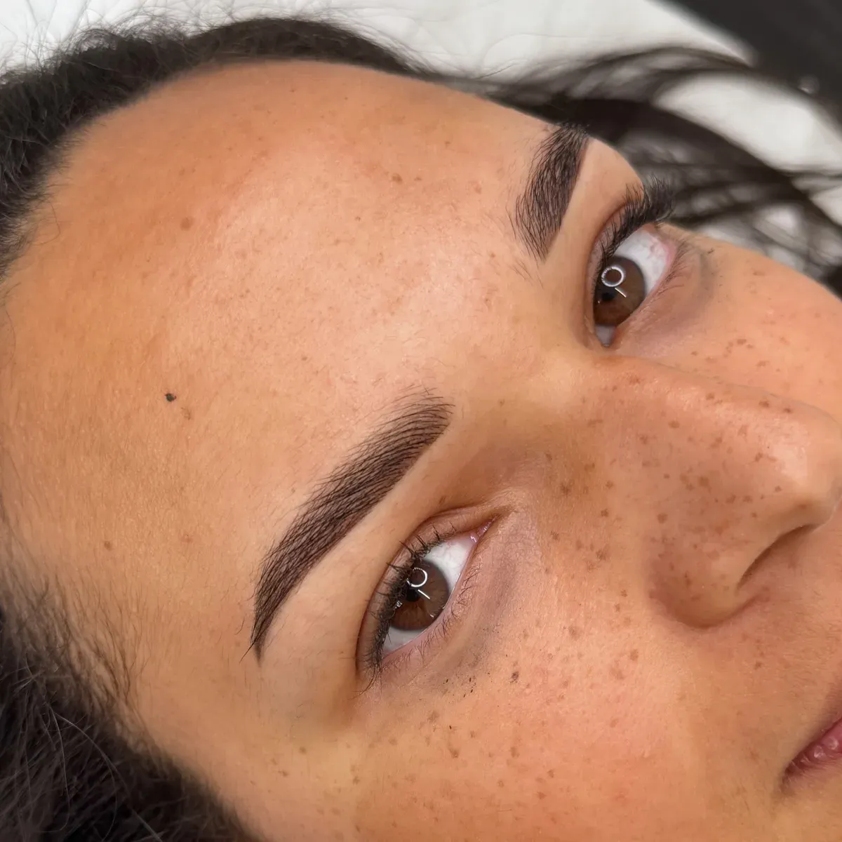 Pecas cicatrizadas en una piel morena