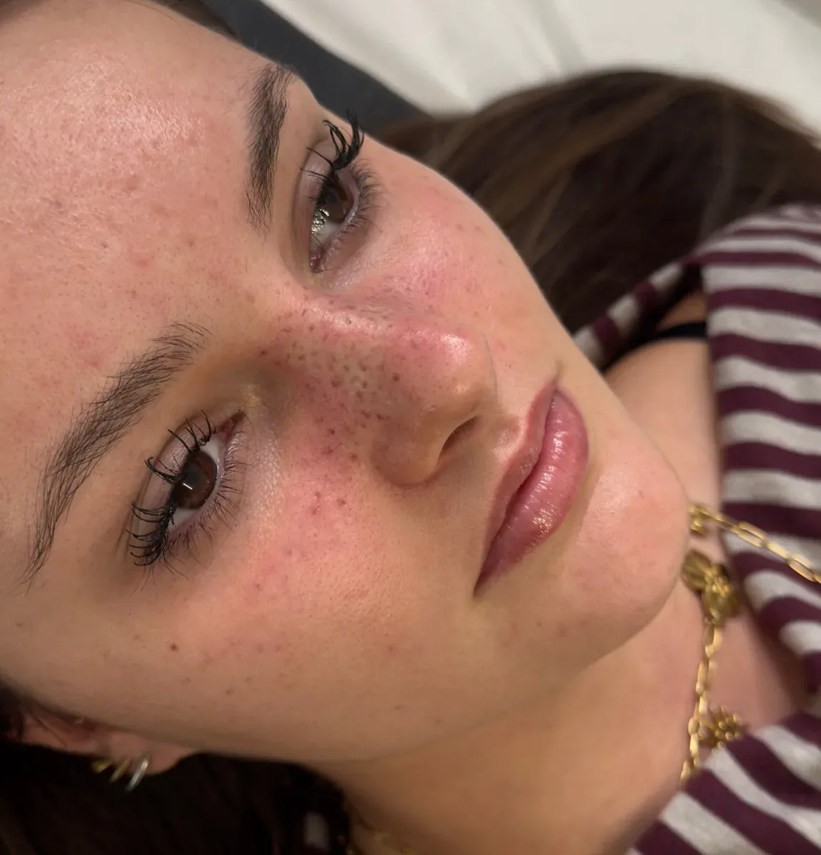 A size S freckle tattoo, right after being done by hand