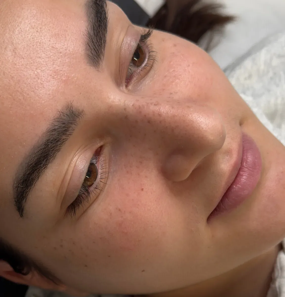 Clienta 2, después: sus pecas cicatrizadas 1 mes más tarde