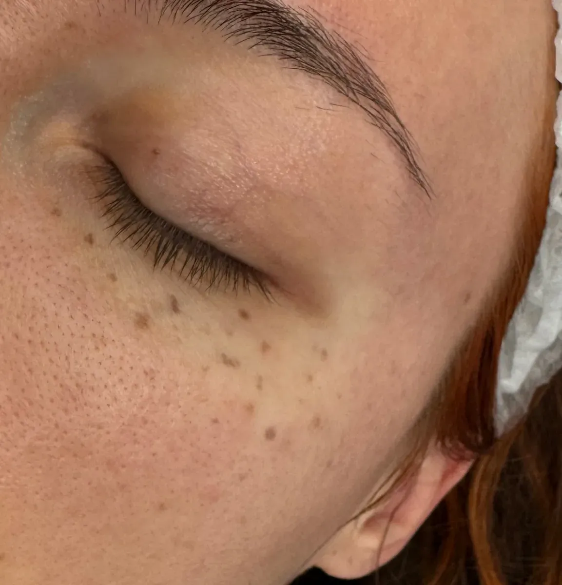 Pecas demasiado opacas y oscuras: efecto lunar
