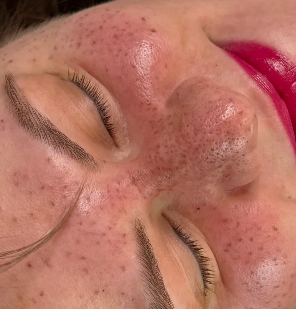 Very oily skin, right after pigmentation
