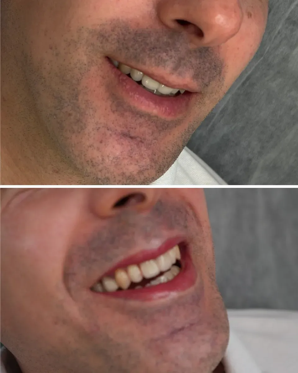 A man before, then right after full lip color with orange-red undertones