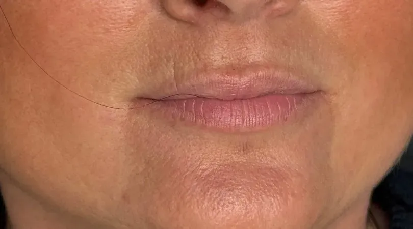 Mature lip before full lip color