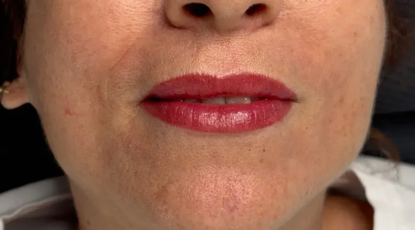 Right after: gentle technique, slight swelling