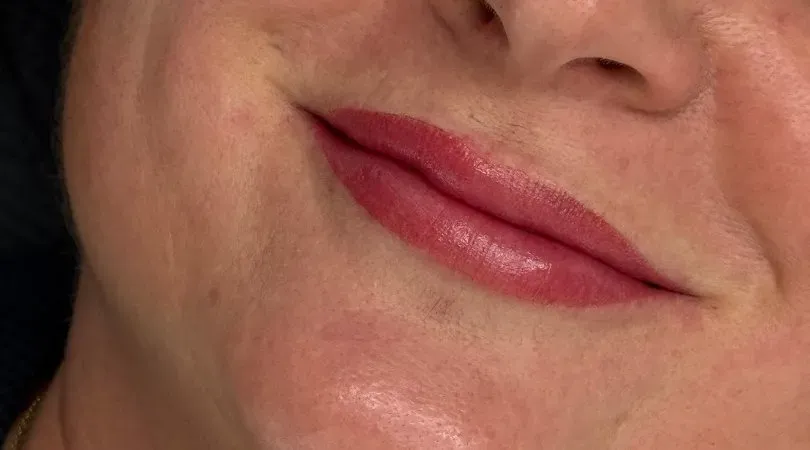 The same lip right after: gentle technique, slight swelling
