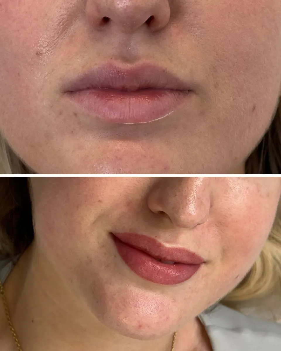 Before, then right after the session: almost no swelling
