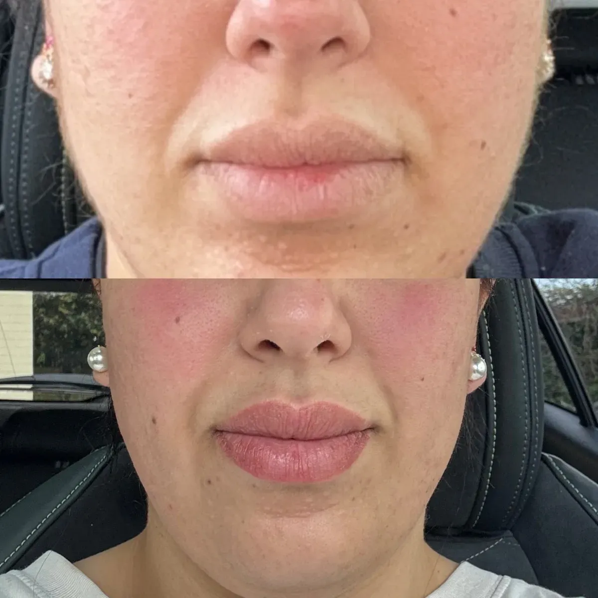 Labio pálido antes, y después con un full lips cicatrizado: el contraste da sensación de volumen
