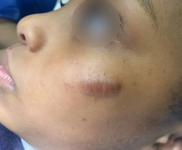 Example of a keloid on the face: a raised scar, wider than the original wound