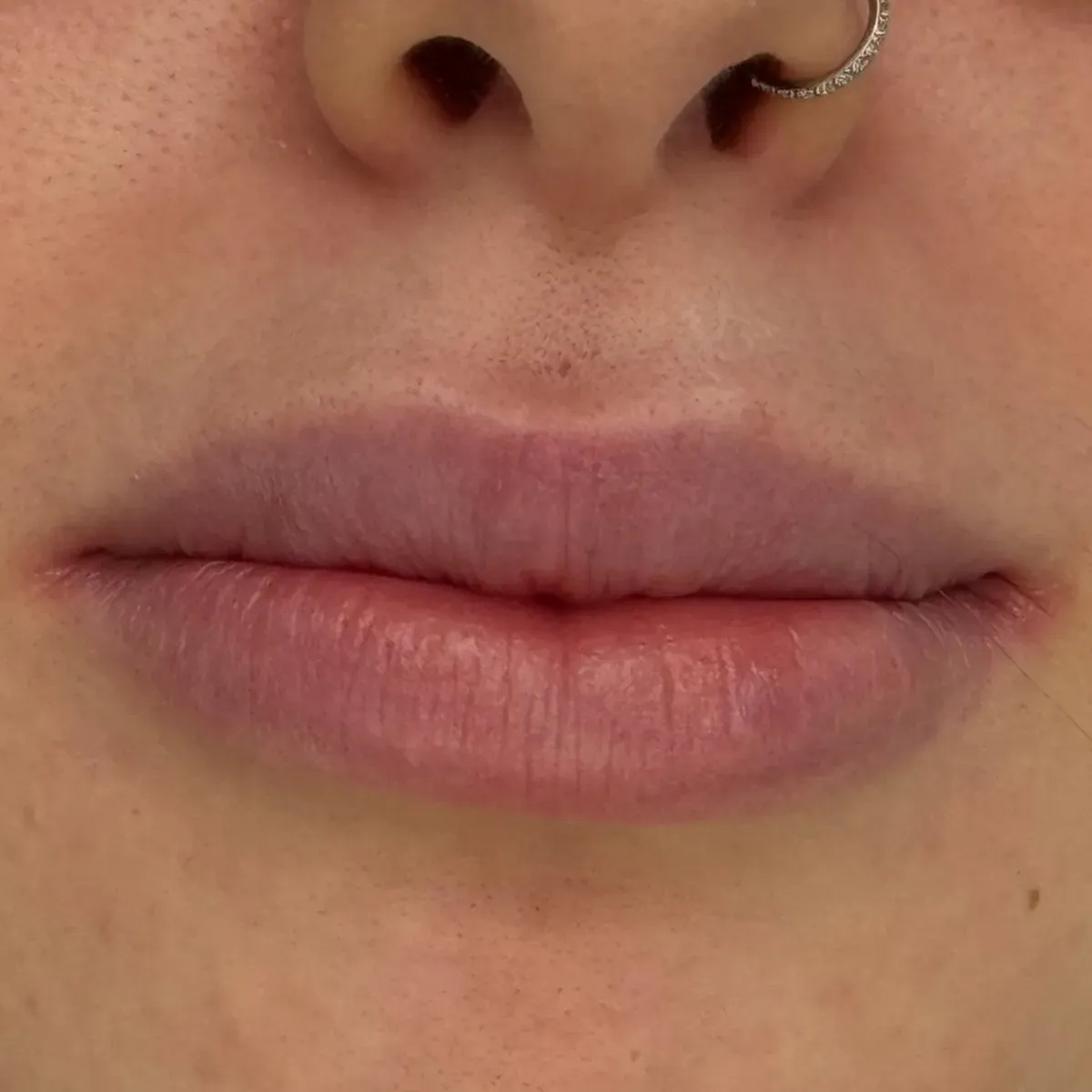 Type 1: a natural lip with lots of filler, very taut, with a smooth surface