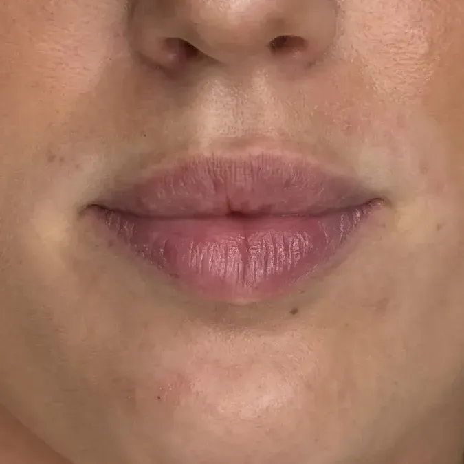 Type 2: a lip with a reasonable amount of filler, fine lines and creases still visible
