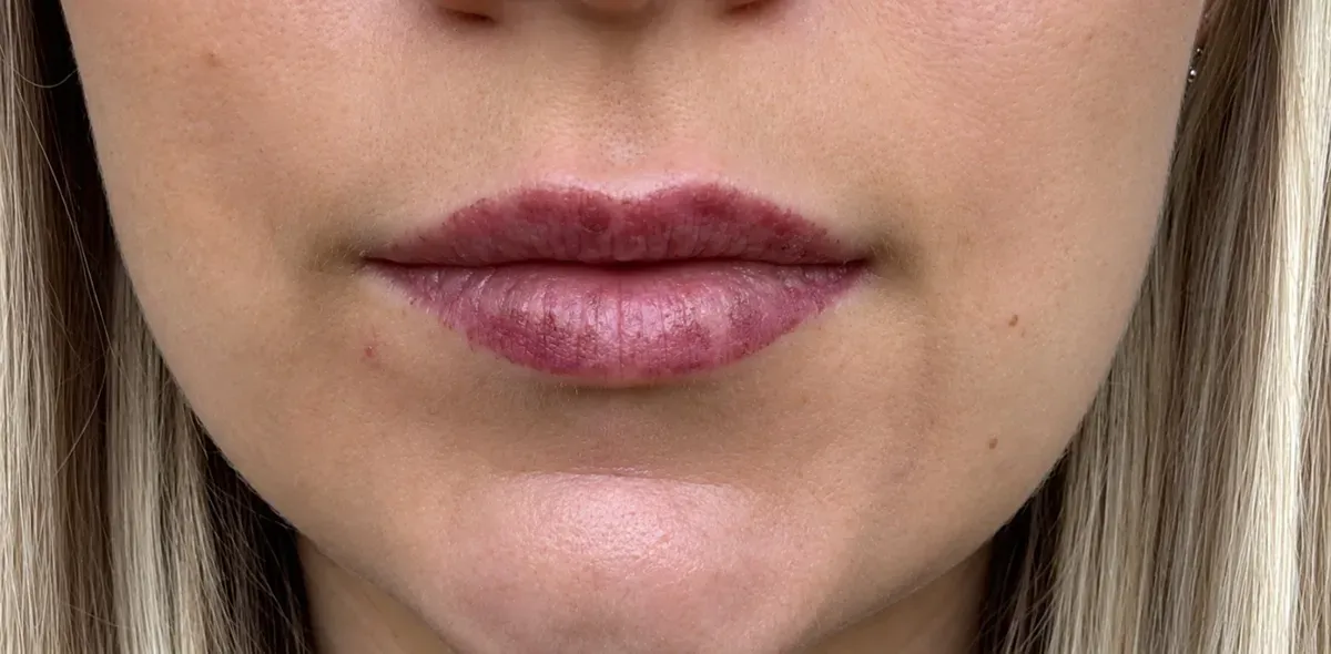 Etapa 2: los labios se pelan
