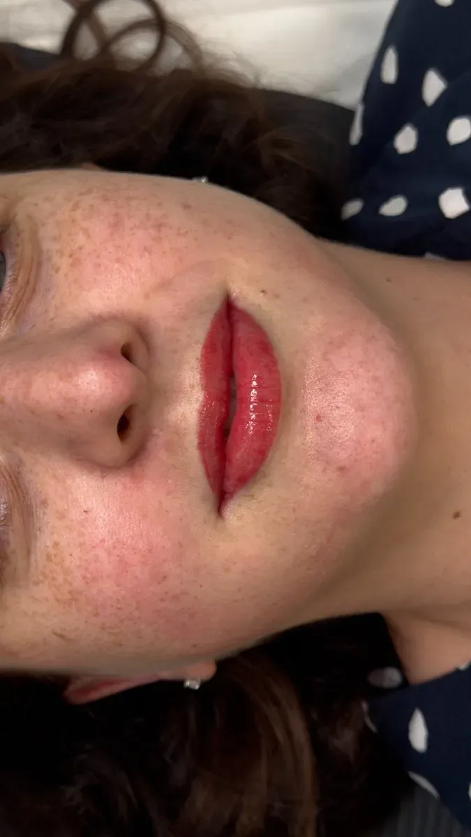 Lips right after the session: the color is brighter than once healed