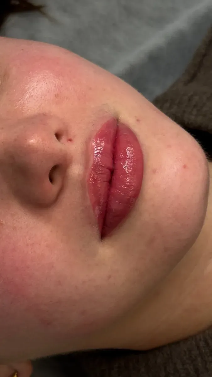 Lips right after the session: the color is brighter than once healed
