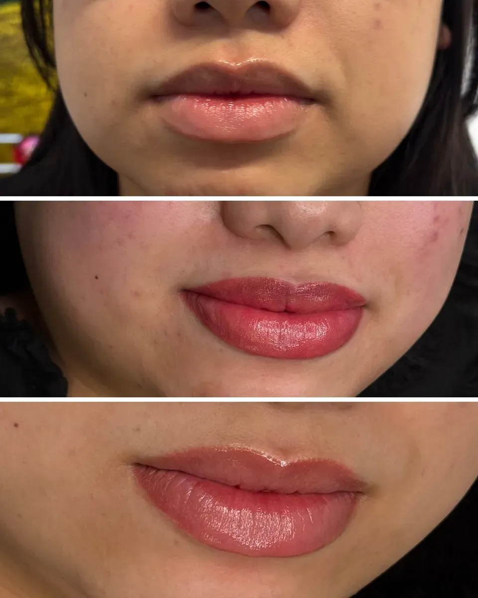 Leicht bräunliche Lippen: vorher, direkt danach, dann abgeheilt