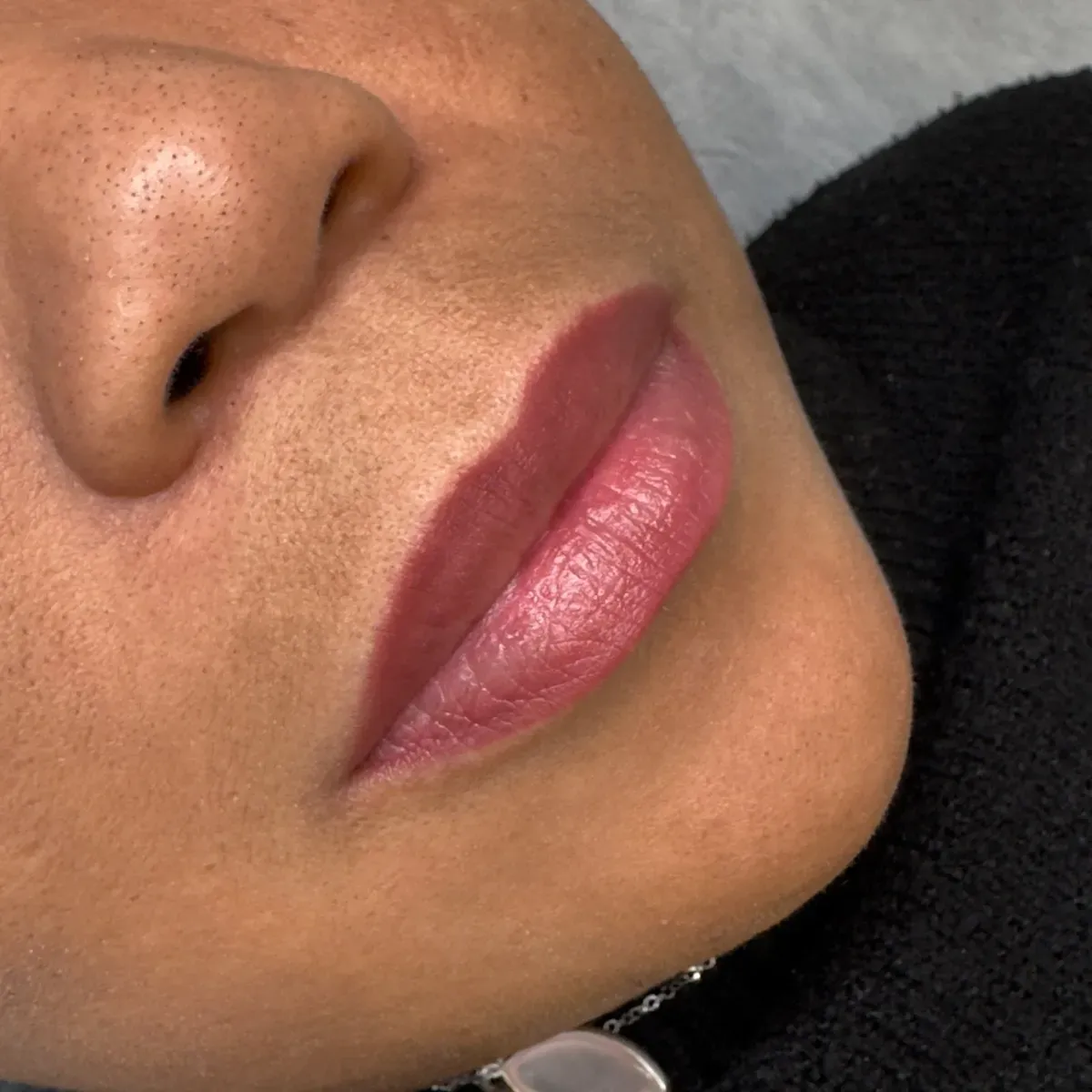 Labios neutralizados, resultado cicatrizado