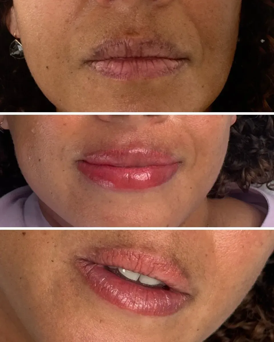 Dunkle, unregelmäßige Lippen (Sonnenflecken): vorher, direkt danach, dann abgeheilt