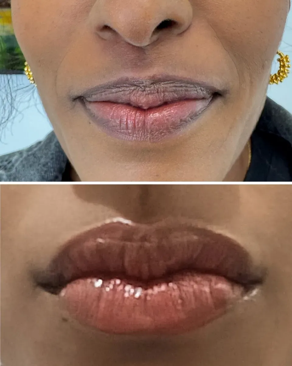 Very dark lips: before, then healed