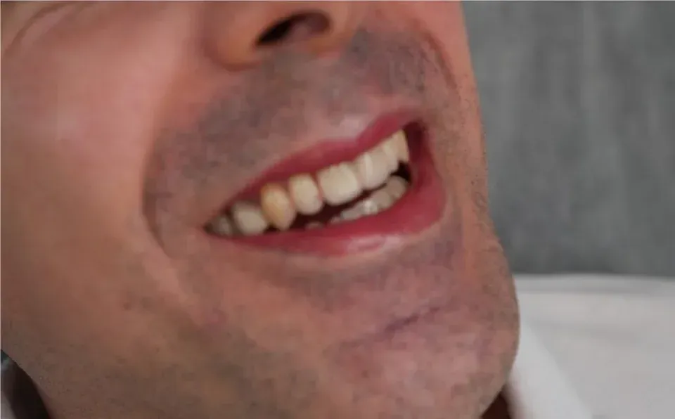 A man's lips right after the procedure