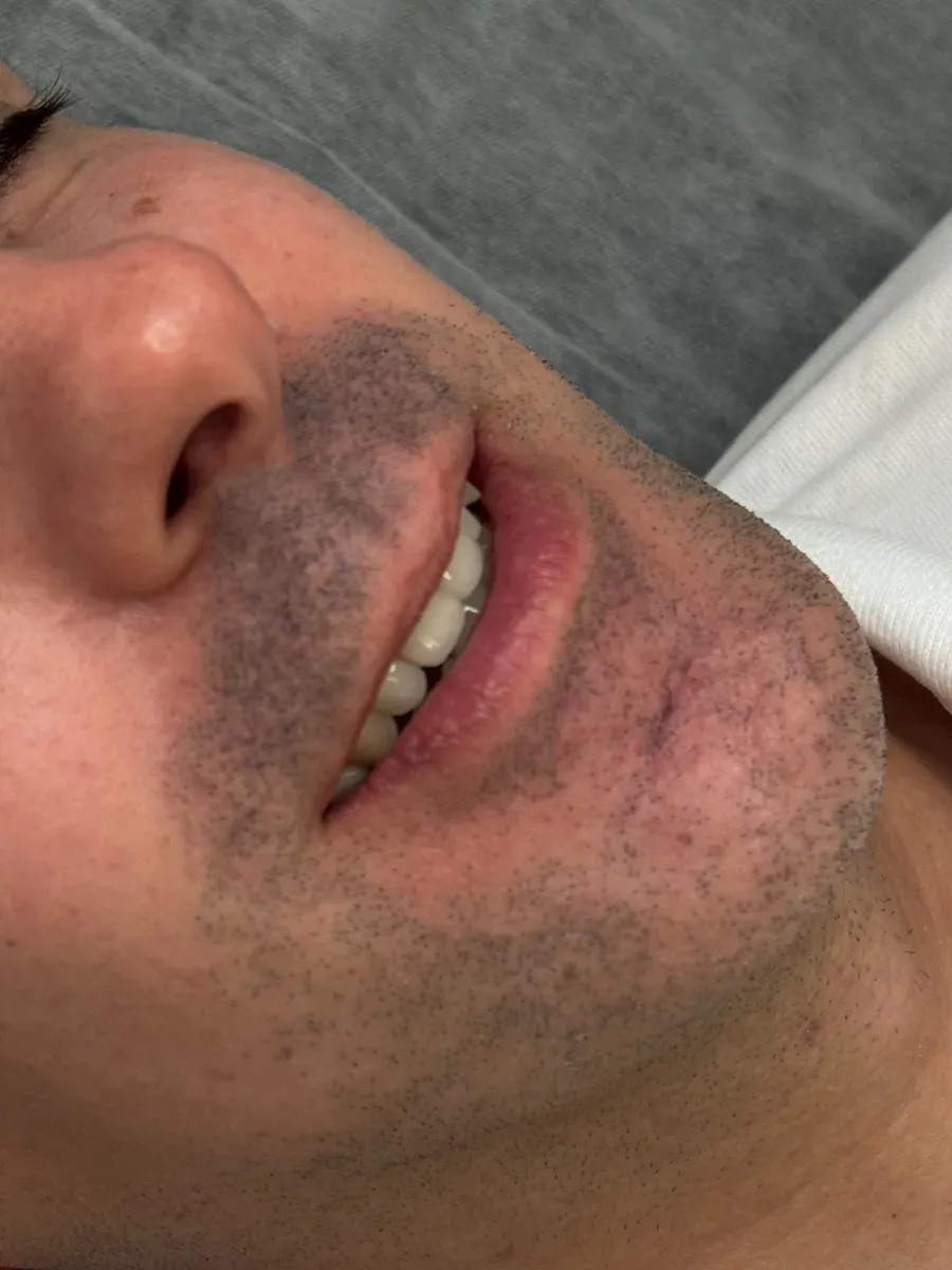 Los labios de un hombre tras una micropigmentación de labios discreta