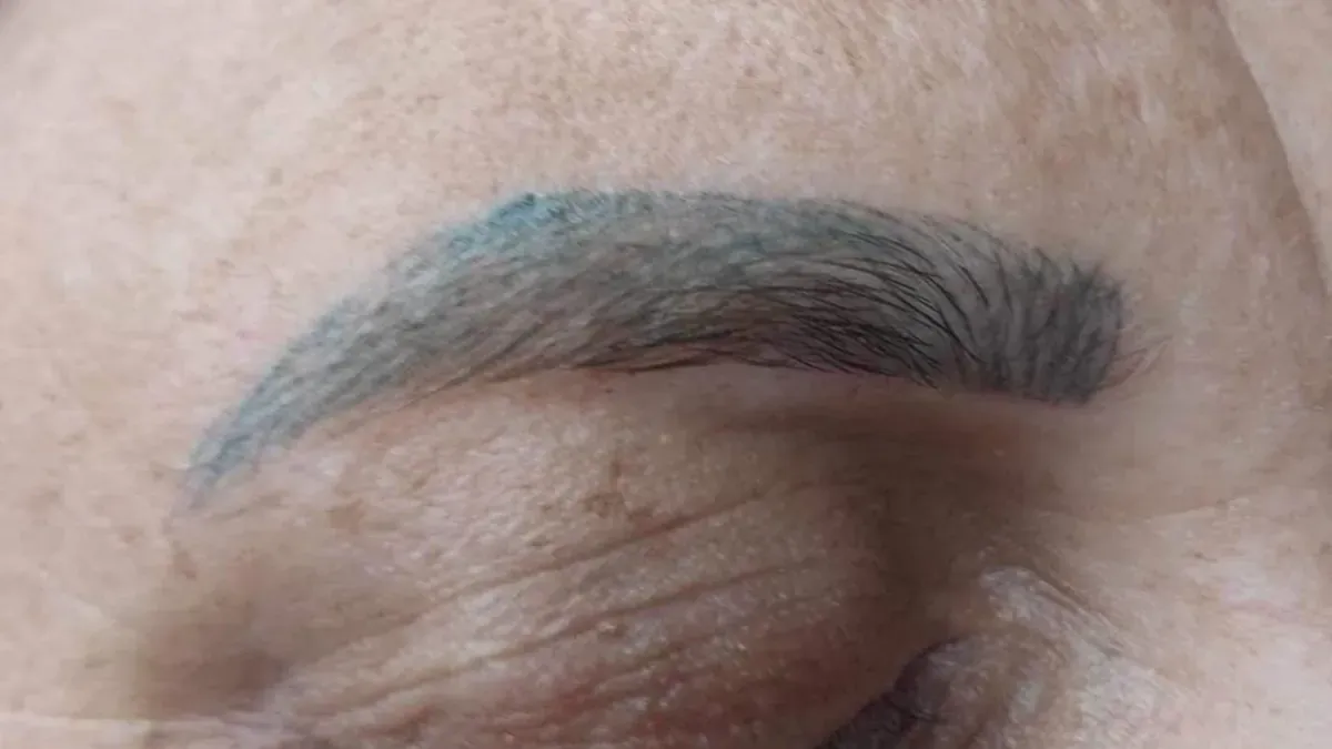 Microblading that turned blue-green: laser tattoo removal required