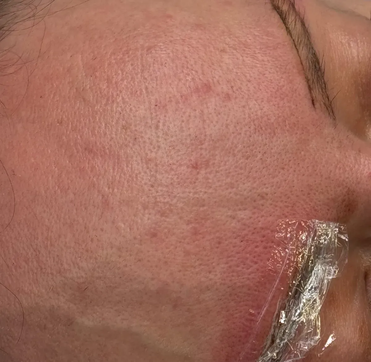 Oily skin with enlarged pores around the brows