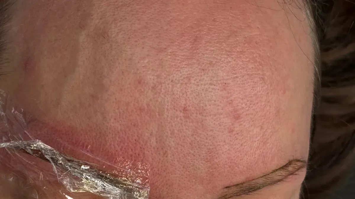Forehead with oily to very oily skin and very enlarged pores
