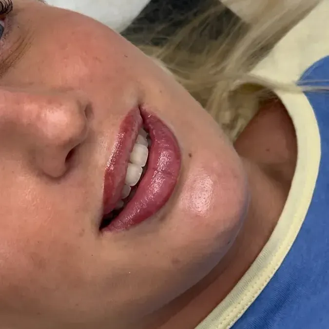 3D effect on lips with filler