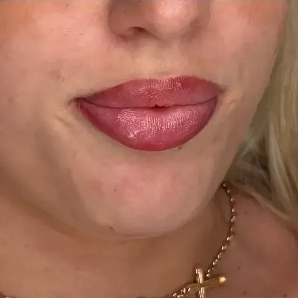 3D effect on lips with filler