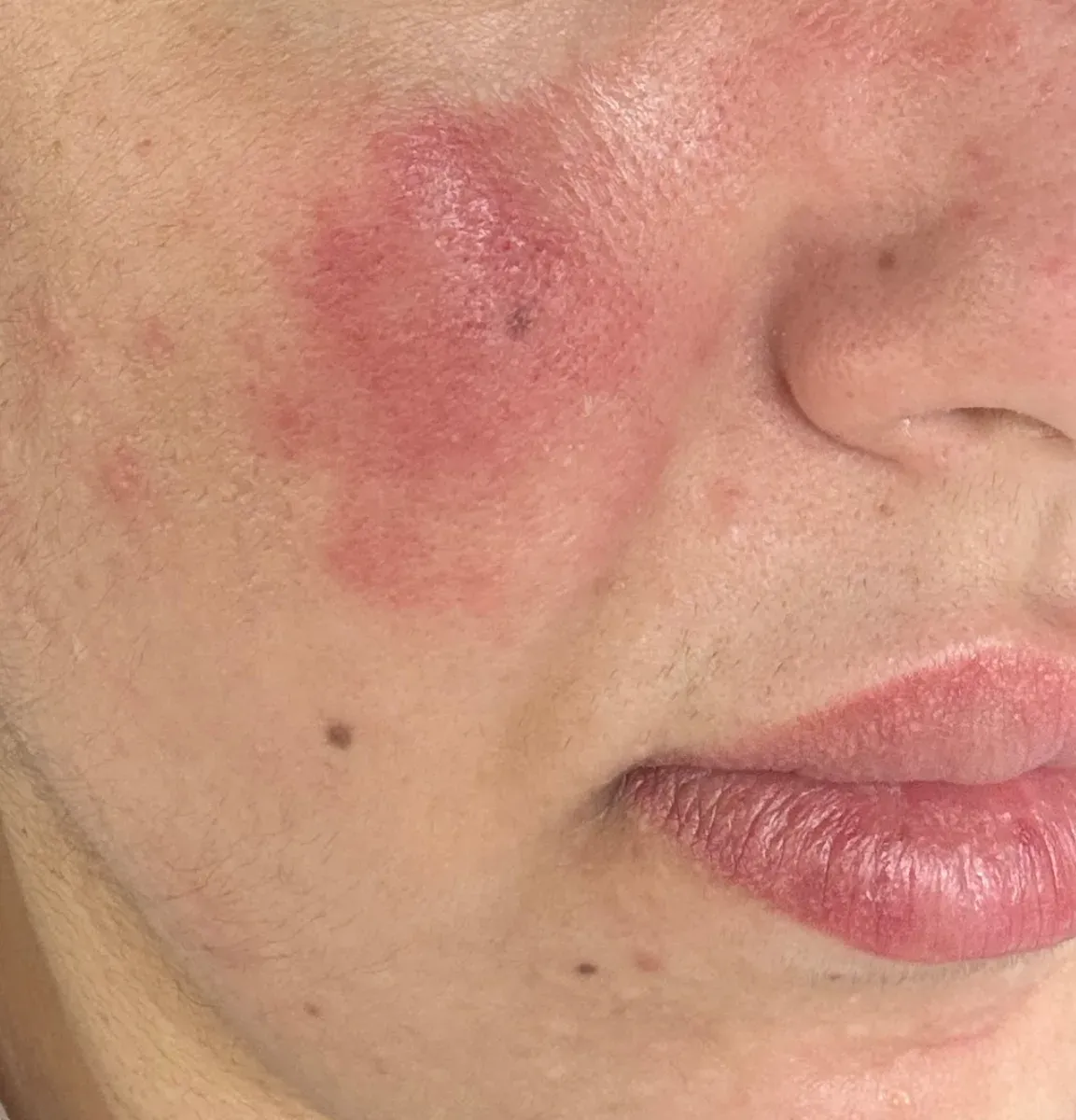 Skin in a rosacea flare-up: no tattooing